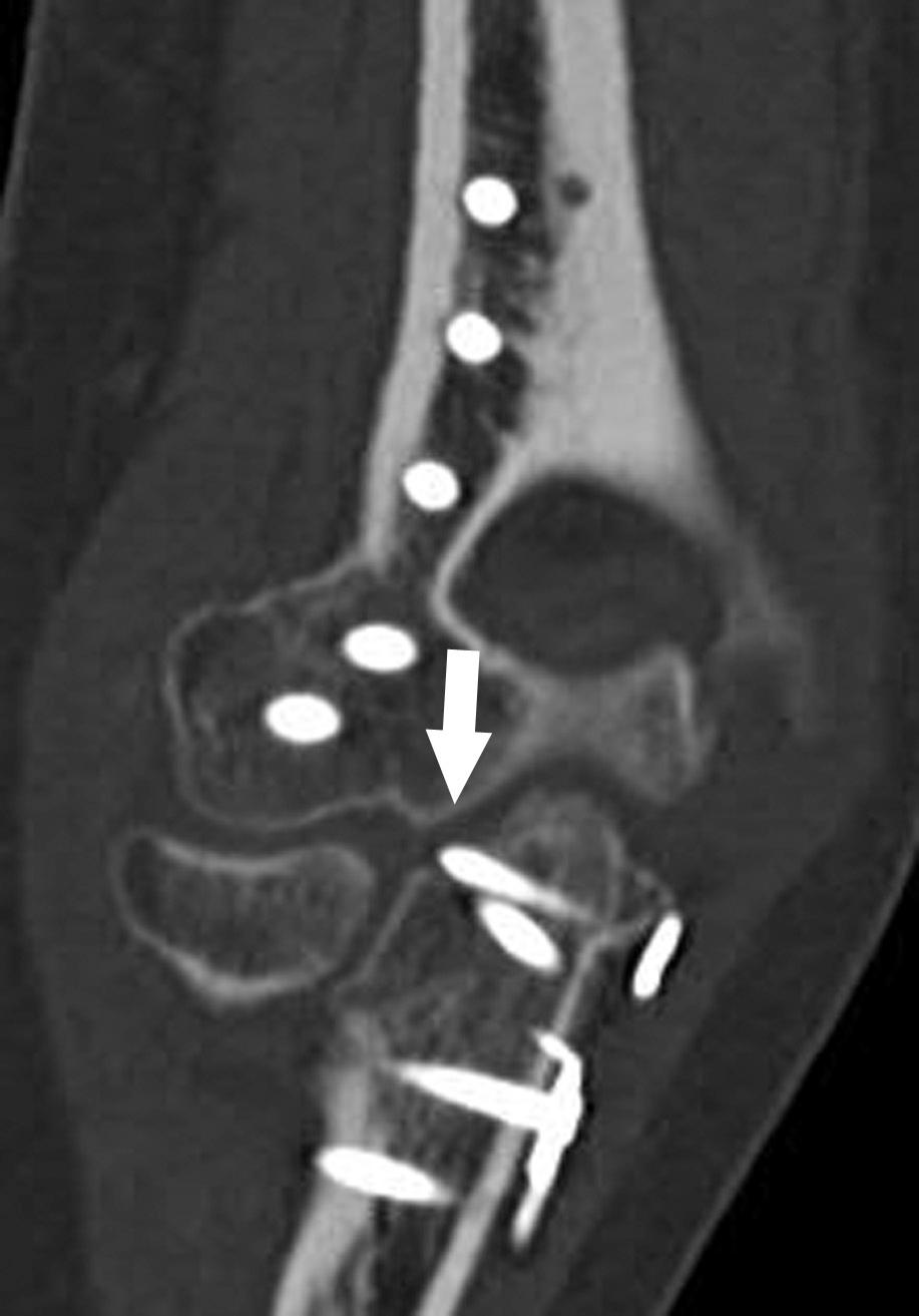 FIG 7.1, A 19-year-old female collegiate golfer and softball player who underwent distal humeral and proximal ulnar fixation for communicated fractures that occurred during a sledding accident who had persistent pain. Two-dimensional coronal oblique dual-energy CT monoenergetic reconstruction of the elbow demonstrates complete suppression of metallic streak artifact with visualization of a screw tip projecting into the joint ( arrow ). Following hardware removal, the patient's pain completely resolved and she has resumed collegiate sports.