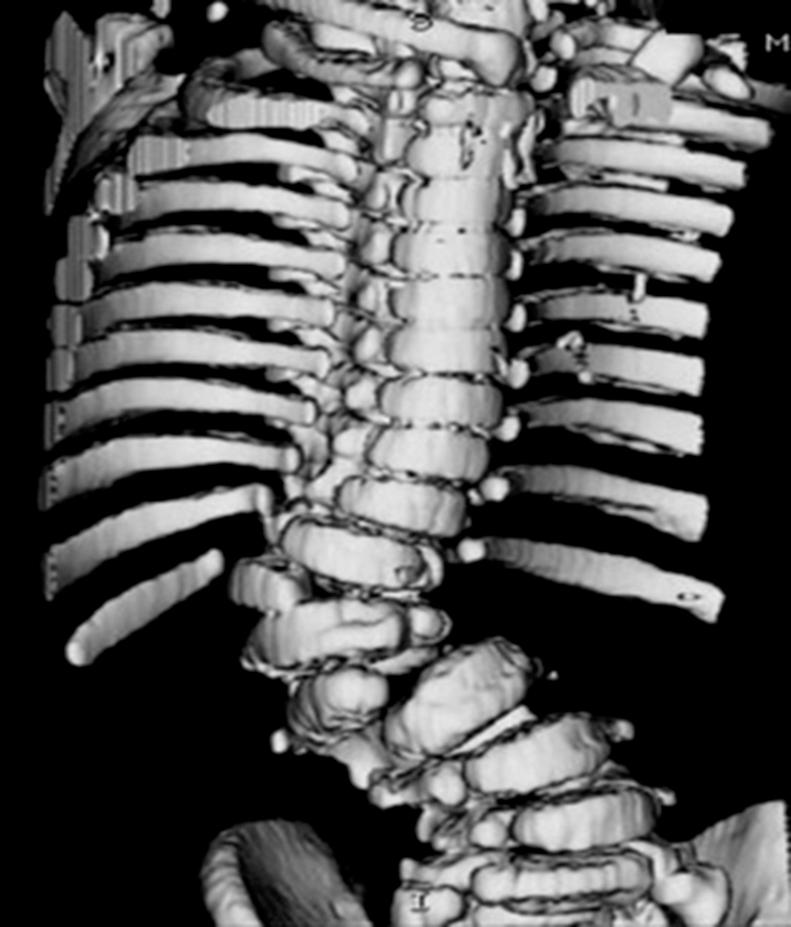 Fig. 11.1, Three-dimensional computed tomography of a patient with scoliosis due to multiple hemivertebra.