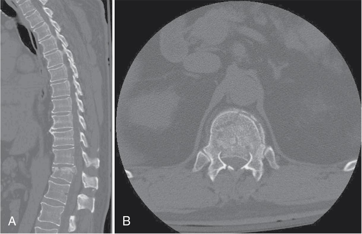 Fig. 11.2, T12 burst fracture.