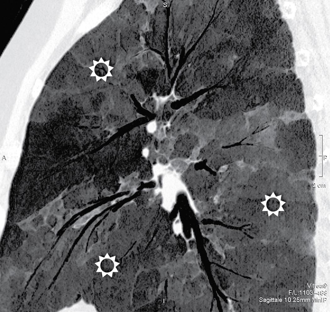 Figure 4.11, Sagittal view (minimum intensity projection image) of a lung in a patient with patchy areas of increased opacity (suns) . Note how easily the extension of the opacities is grasped with this technique and how precisely the bronchial elements inside them are depicted.