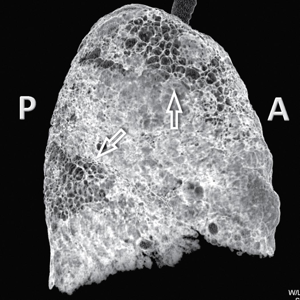 Figure 4.12, Tridimensional external lateral view of a lung in a patient with patchy hyperlucencies due to idiopathic usual interstitial pneumonia (arrows) . With this technique (tridimensional volume rendering), it is possible to obtain synthetic and effective visions of both lung surfaces from different points of view. A , Anterior; P , posterior.