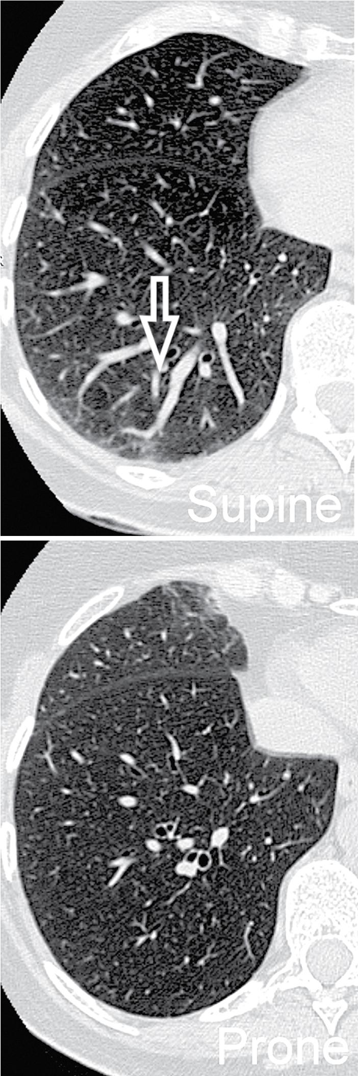 Figure 4.13, Supine (top) and prone (bottom) axial views of the right lung approximately at the same level. In the supine scan, there is an area of faint increased attenuation in the subpleural region (arrow) . The opacity disappears in the prone position, so it should be functional and not due to lung pathology.