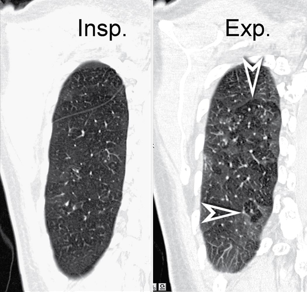 Figure 4.14, Frontal view of the right lung of a patient with constrictive bronchiolitis. The existence of patchy areas of different density due to air trapping is better demonstrated by the expiratory scan (arrowheads) . Exp ., Expiratory scan; Insp ., inspiratory scan.