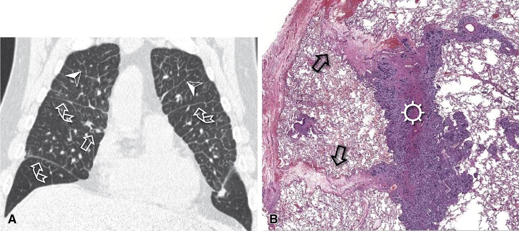 Figure 4.15, Septal pattern. Rad-Path correlation. CT image shows a thickening of interlobular septa (arrowheads) and fissural interstitium (curved arrows) associated with peribronchovascular cuffing (arrow) ; the architecture is overall preserved (A). On histology, interlobular septa are markedly widened both by the presence of a neoplastic component (sun) , creating a nodular septal pattern, and by septal edema ( arrows ), which corresponds to a smooth septal pattern. Nevertheless, the lobular architecture is preserved overall (B, lymphangitic carcinomatosis from metastatic adenoid cystic carcinoma, H&E).