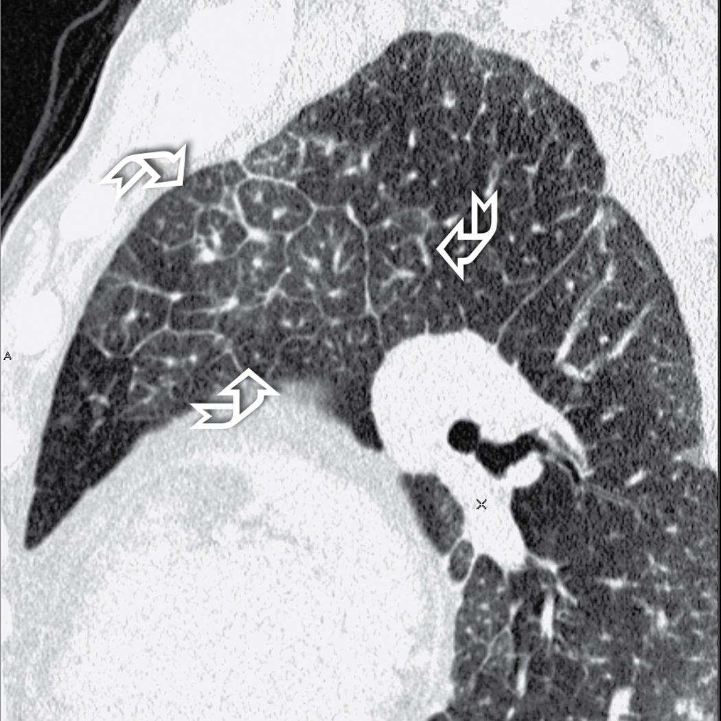 Figure 4.16, Septal pattern. This sagittal view shows thickened septa in the upper lobe (curved arrows) . The thickening of the interlobular septa outlines secondary pulmonary lobules of various sizes.