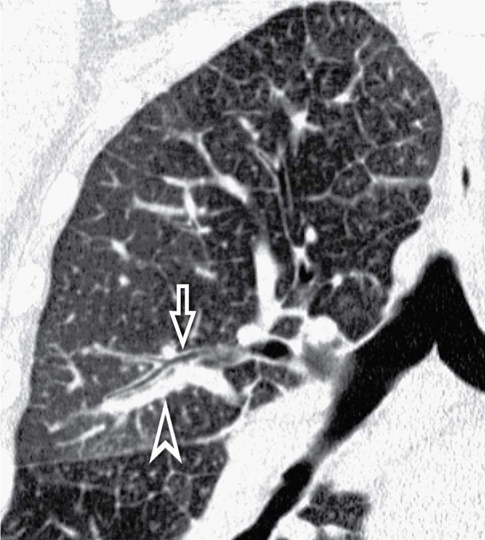Figure 4.18, Septal pattern. Central peribronchovascular thickening is visible. In this coronal image, there is a thickening of the central peribronchovascular interstitium that manifests as peribronchial cuffing of segmental bronchi (arrow) and increased size of the companion arteries (arrowhead) .