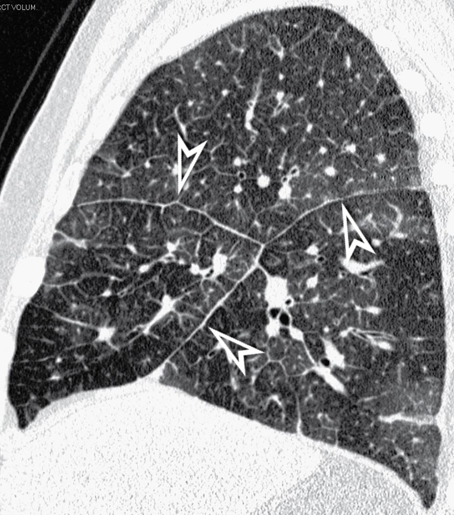 Figure 4.19, Septal pattern. Subpleural interstitial thickening is easily recognizable in relation to the fissures (arrowheads) .