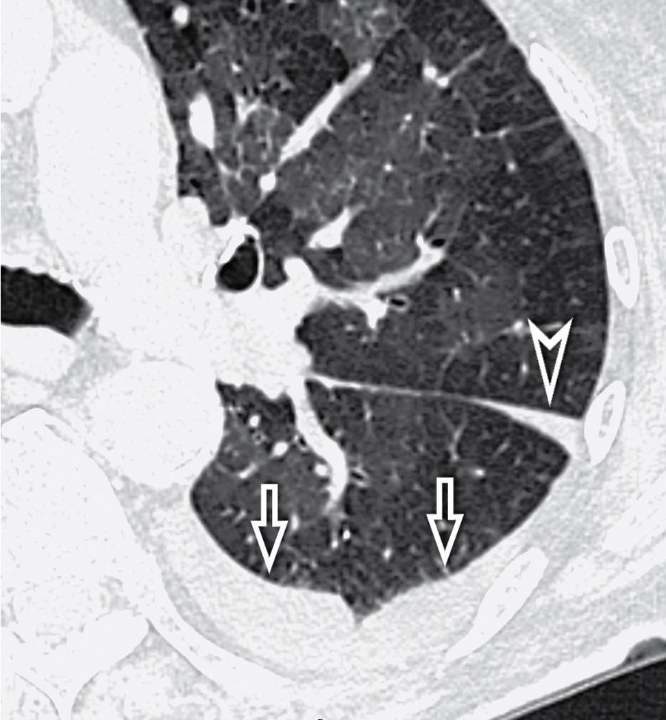 Figure 4.20, Septal pattern. A pleural effusion is visible in this image along the costovertebral angle as a meniscus (arrows) and along the fissure (arrowhead) .