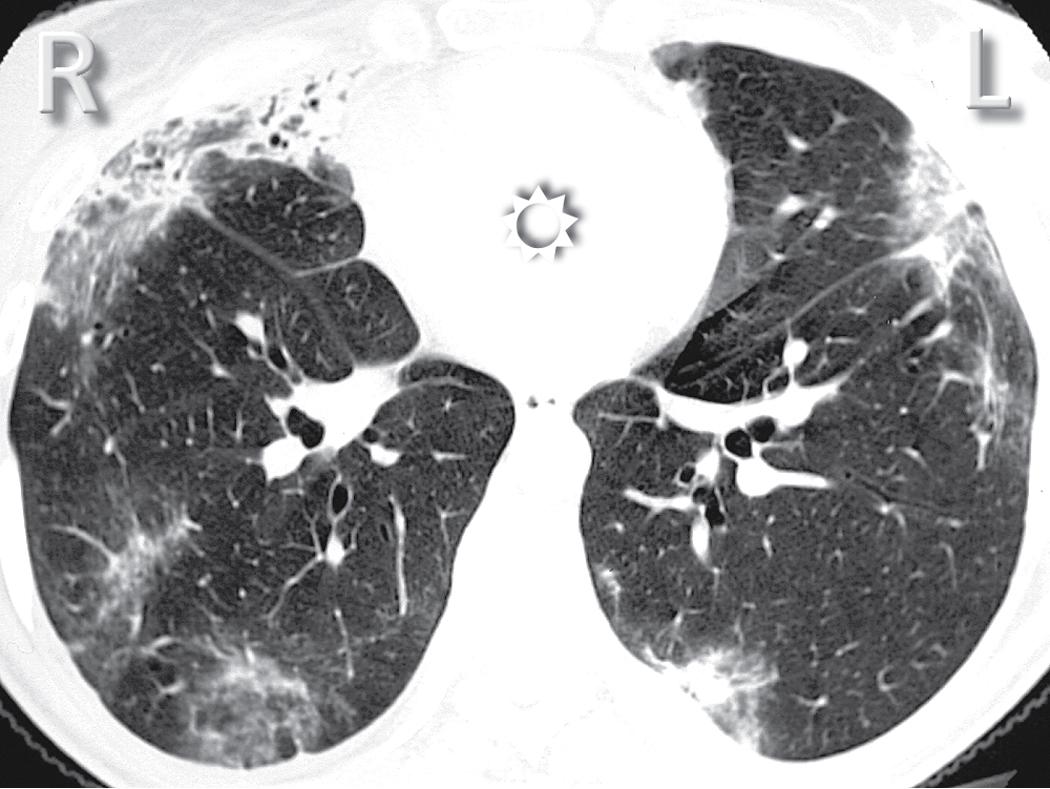 Figure 4.2, Computed tomography transverse (axial) view of the lungs at the level of the heart (sun) (case with lung pathology). In the axial images, it seems as if the patient were seen from below; consequently the right lung is to the left of the viewer. L , Left; R , right.