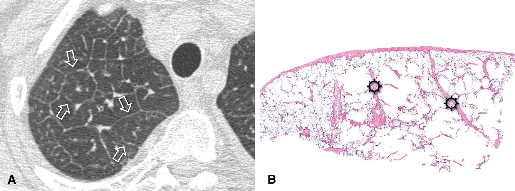 Figure 4.21, Septal pattern, subset smooth. (A) CT image shows polygonal outlines of the lobules without focal abnormalities (arrows) . Smooth thickening of the peribronchovascular interstitium is also visible. (B) On histology, smooth thickening of interlobular septa (sun) is apparent at low power. The visceral pleura is slightly thickened (Erdheim-Chester disease, H&E).