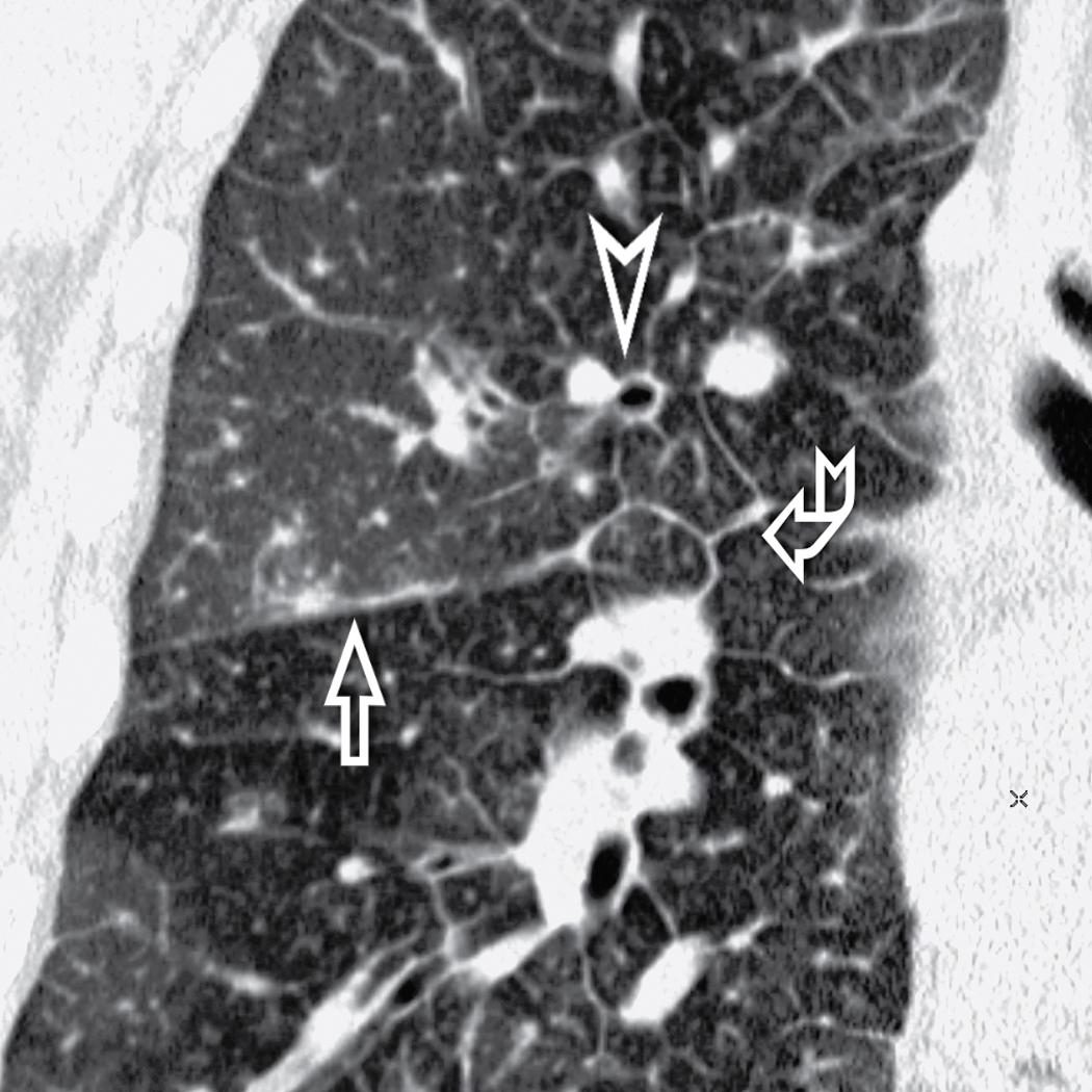 Figure 4.22, Septal pattern, subset smooth. This coronal view shows smooth thickening of a fissure (arrow) , of the perilobular interstitium (curved arrow) , and of the peribronchovascular interstitium (arrowhead) .