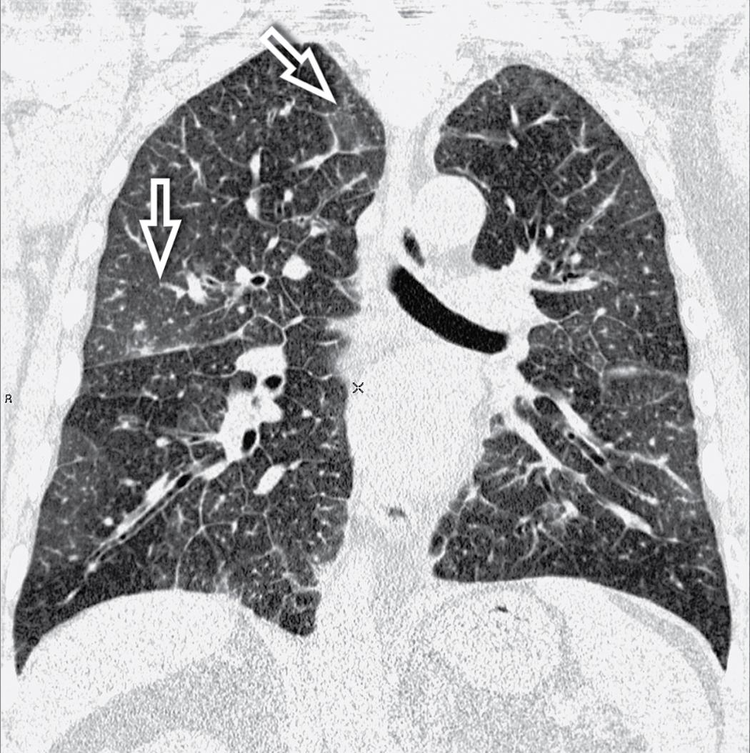 Figure 4.23, Pulmonary edema. This coronal view shows bilateral smooth perilobular, peribronchovascular, and subpleural thickening ( Fig. 4.22 is a close-up of this image). Areas of faint ground-glass opacity are also present (arrows) .