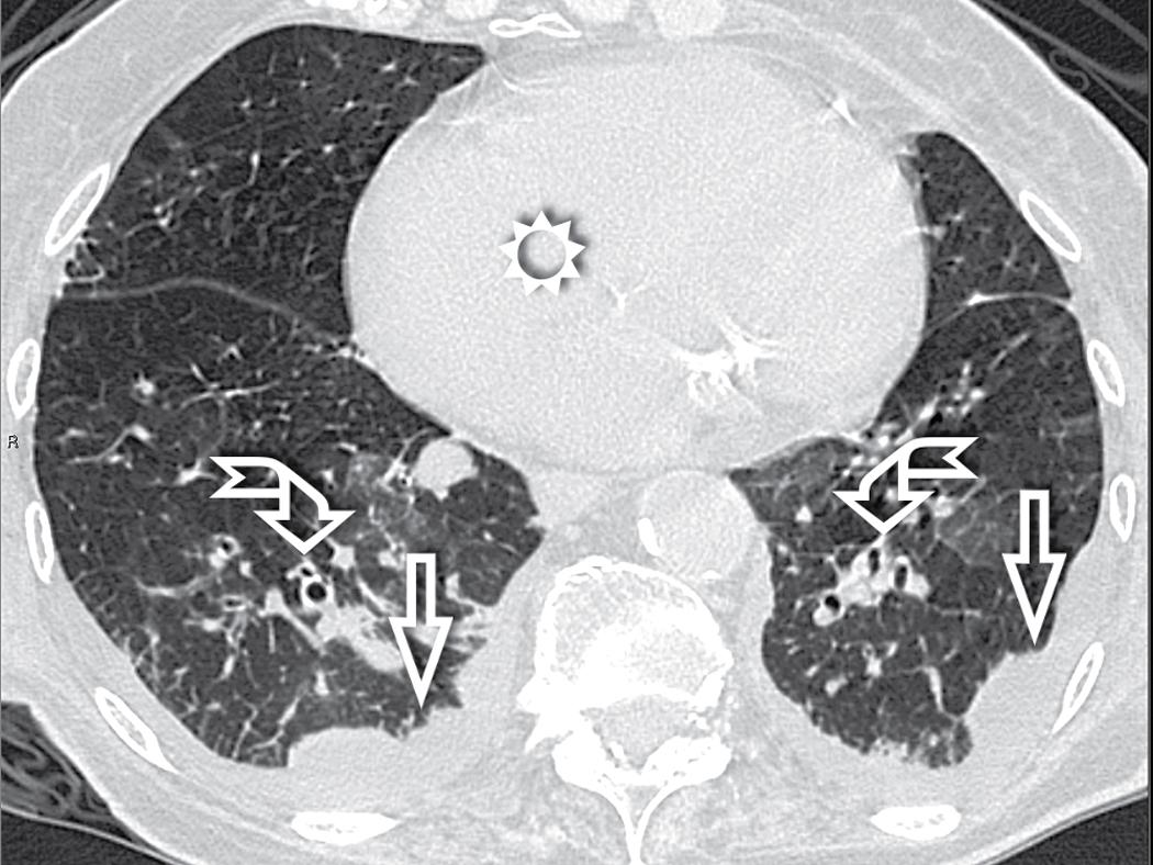 Figure 4.24, In a patient with hydrostatic pulmonary edema due to heart failure, the image reveals the posterior (gravitational) prevalence of bronchial cuffing (curved arrows) and bilateral pleural effusion (arrows) . Note also the enlarged heart (sun) .