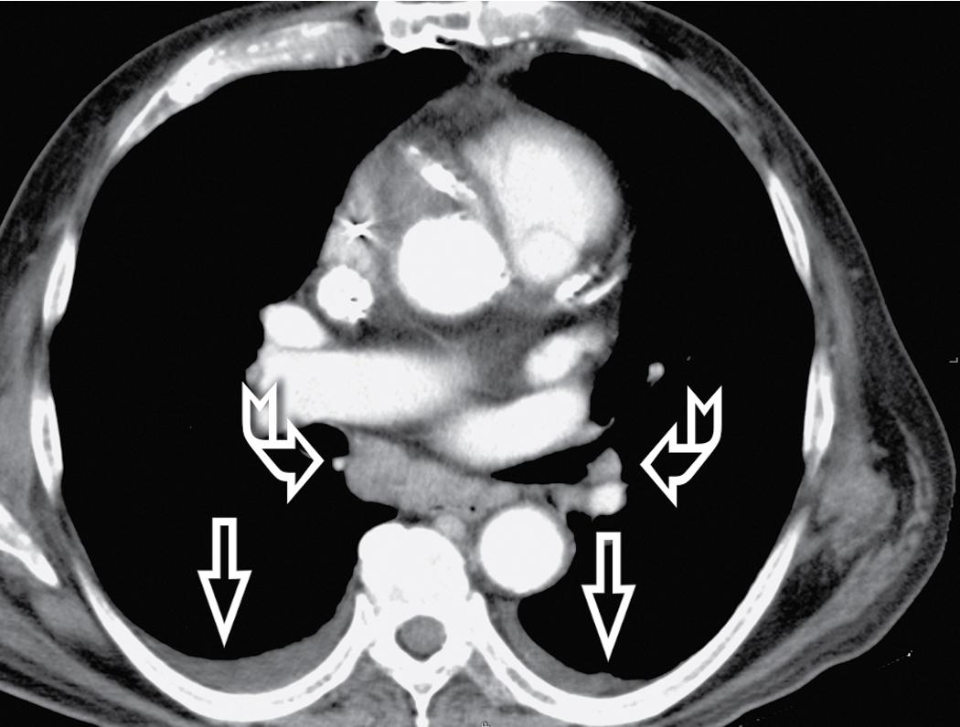 Figure 4.25, Axial scan (mediastinal window) in a patient with hydrostatic pulmonary edema due to heart failure. Subcarinal enlarged lymph nodes are visible in the mediastinum (curved arrows) . A small bilateral pleural effusion coexists (arrows) .