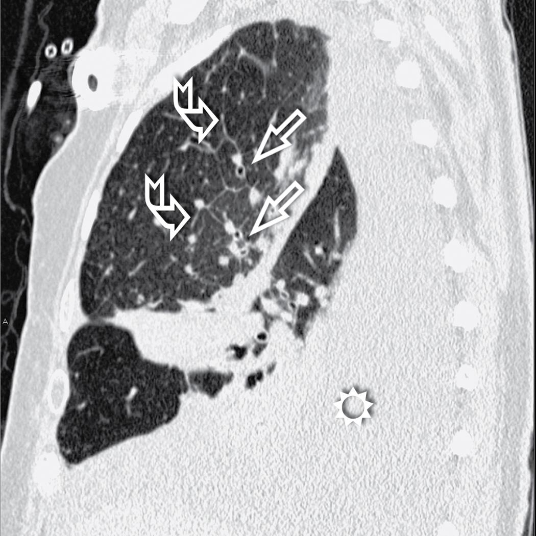 Figure 4.26, Lymphangitic carcinomatosis. Sagittal view shows smooth thickening of interlobular septa in the right upper lobe (curved arrows) and a thickening of the peribronchovascular interstitium, resulting in an increased thickness of bronchial walls and increased size of companion arteries (arrows) . A pleural effusion is also present, with basal (sun) and intrafissural distribution.