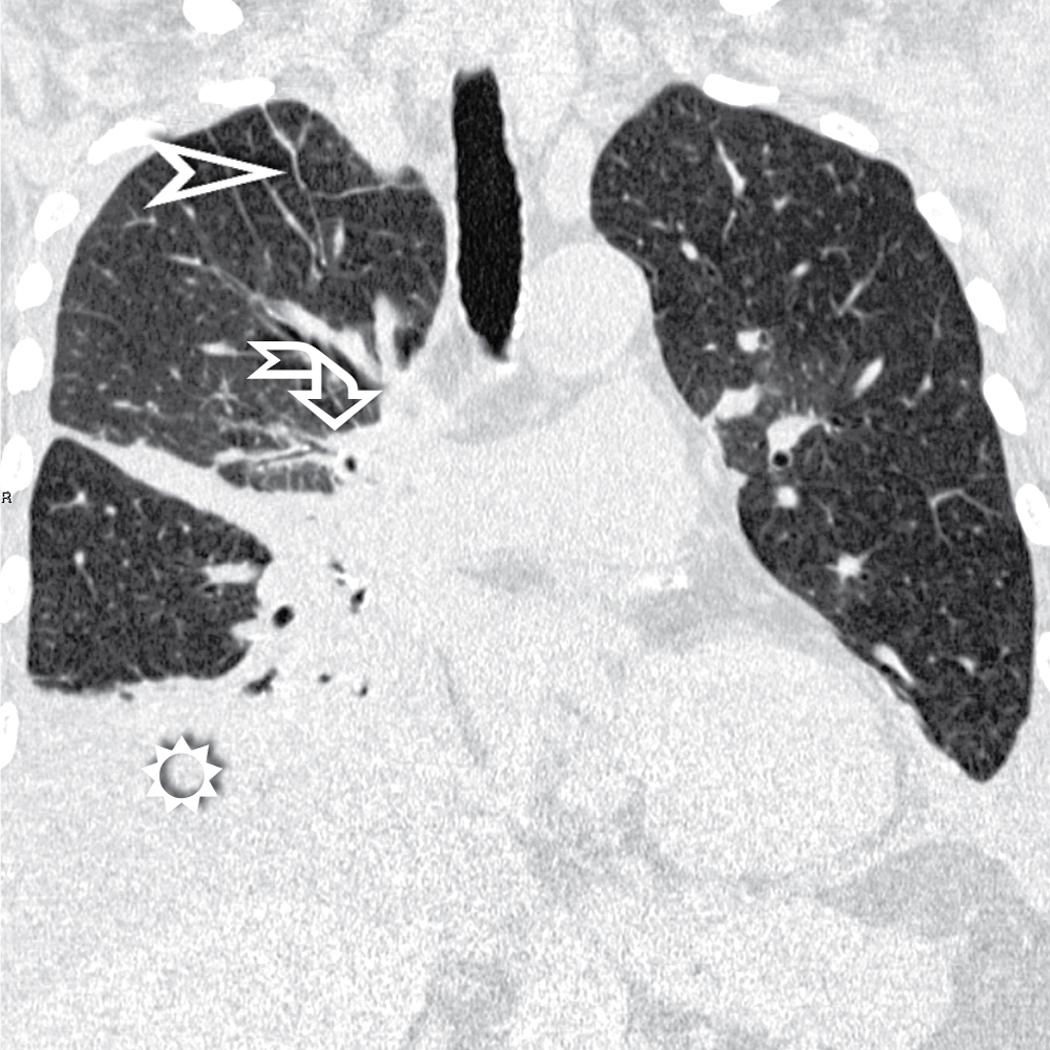 Figure 4.27, This coronal view shows a unilateral lymphangitic carcinomatosis. Note the non–gravity-dependent smooth septal thickening in the right upper lobe (arrowhead) , the thickening of the peribronchovascular interstitium (curved arrow) , and a pleural effusion (sun) , together with lower lobe atelectasis.