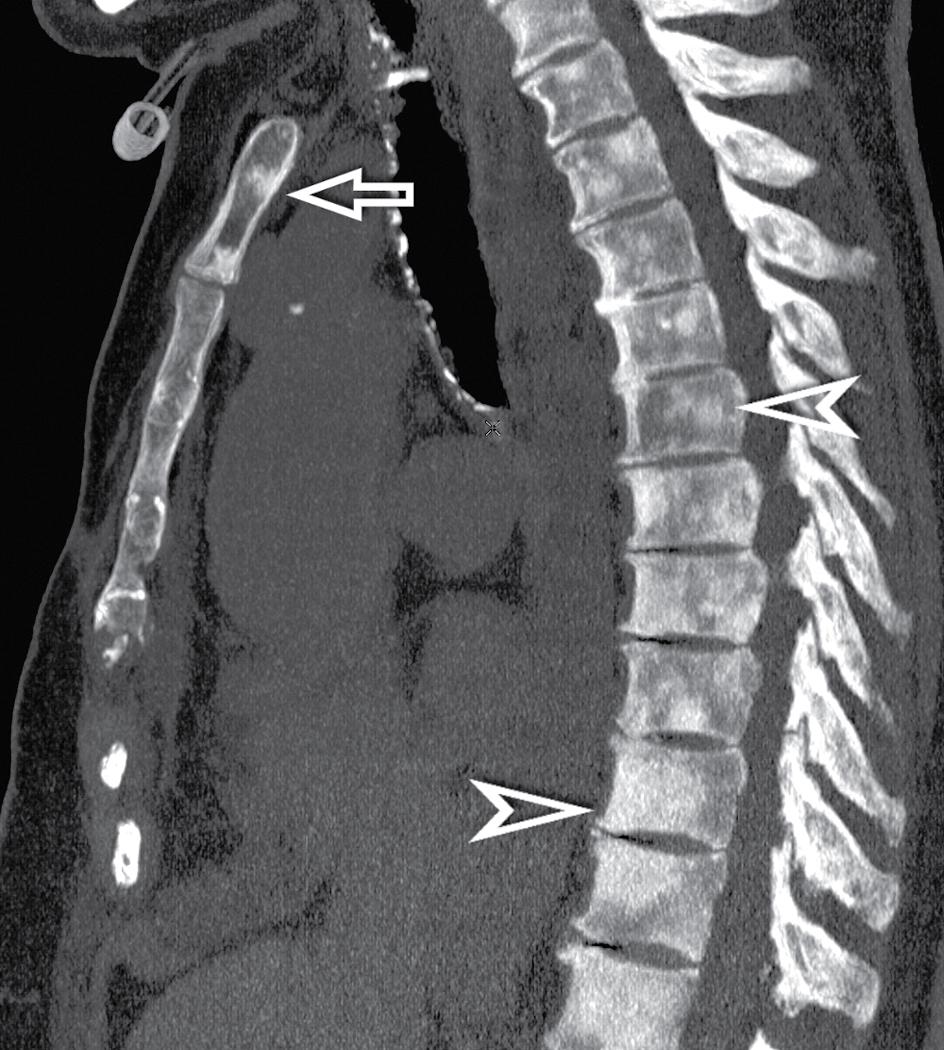 Figure 4.28, Sagittal view at the level of the midline in a patient with multiple skeletal metastases. The image has been documented with bone window settings and shows multifocal spotty white areas in the sternum (arrow) and thoracic vertebrae (arrowheads) .
