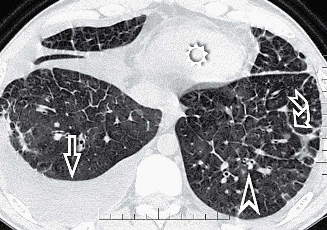 Figure 4.29, Pulmonary venoocclusive disease in a 25-year-old man. The axial computed tomography image shows widespread smoothly thickened interlobular septa (curved arrow) , bronchial cuffing in the centrilobular area (arrowhead) , and a right pleural effusion (arrow) . The sun indicates the heart.