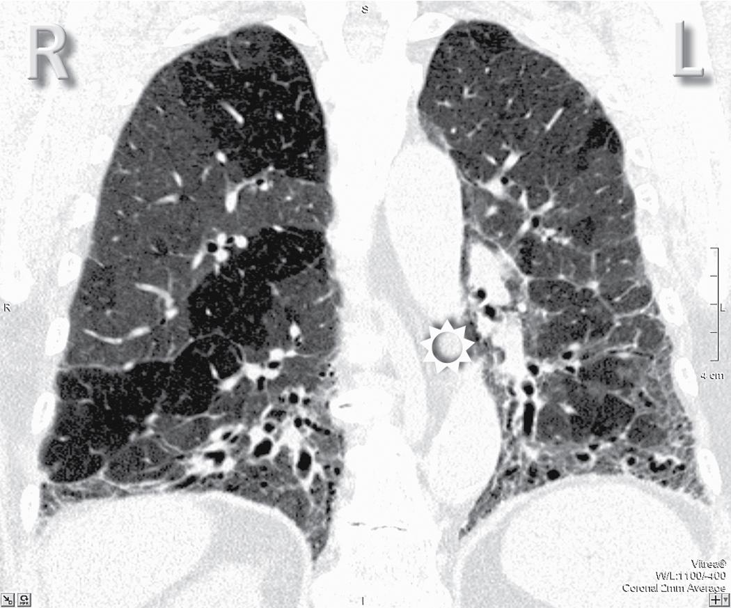 Figure 4.3, Computed tomography frontal (coronal) view of the lungs at the level of the descending aorta (sun) (case with lung pathology). Again, the right of the patient is to the left of the viewer. The patient is always seen vis-à-vis. L , Left; R , right.