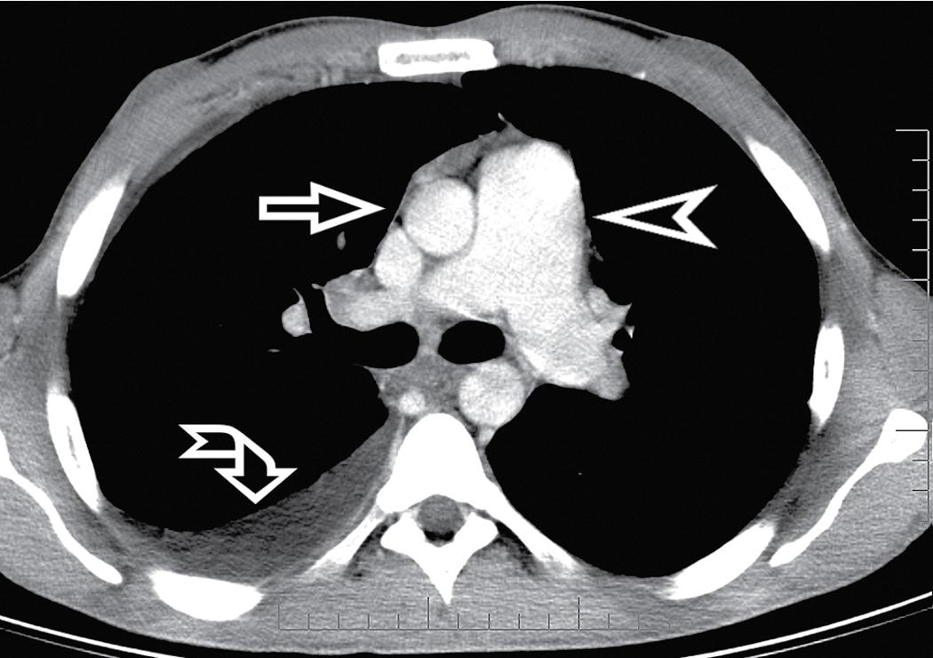 Figure 4.31, A contrast-enhanced axial scan (mediastinal window) of the same patient as in Fig. 4.29 reveals a dilated central pulmonary artery (arrowhead) and a right pleural effusion (curved arrow) . Compare the size of the main pulmonary artery with the diameter of the ascending aorta (arrow) ; they should be the same as in a normal individual.