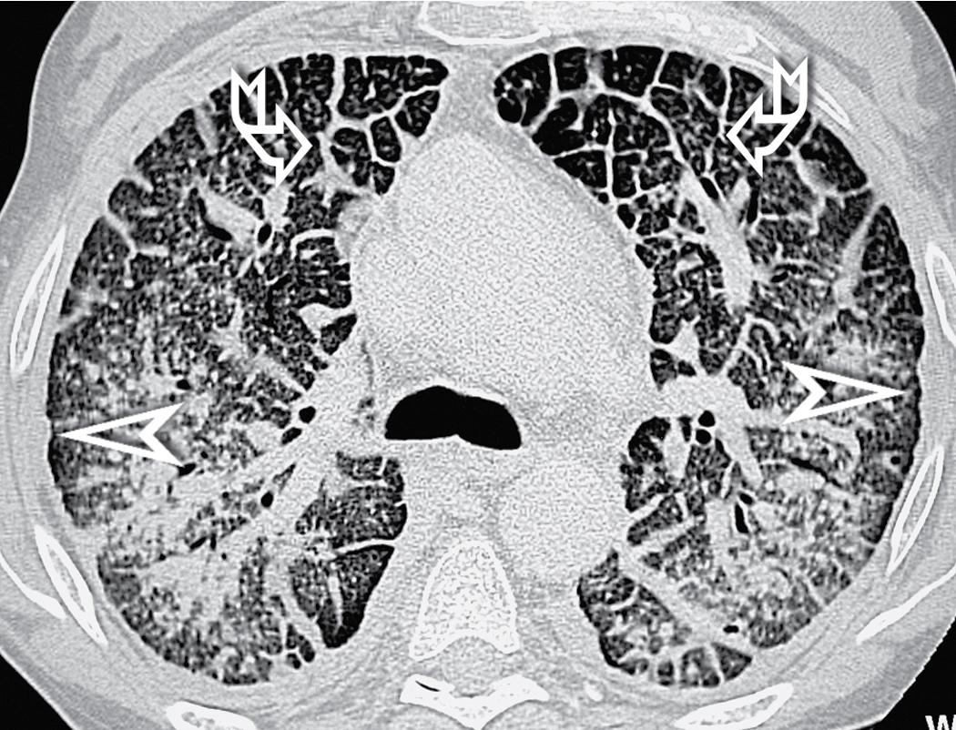 Figure 4.32, Erdheim–Chester disease. Computed tomography scan shows a caricatural bilateral smooth thickening of interlobular septa (curved arrow) and subpleural interstitium along the costal margins (arrowheads) and the fissures.