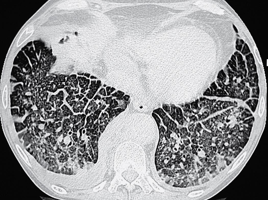 Figure 4.33, Widespread basal septal thickening in the same patient as in Fig. 4.32 .