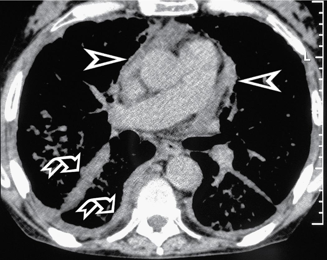 Figure 4.34, Axial scan (mediastinal window) of the same patient as in Fig. 4.32 . An abnormal dense tissue thickens the subpleural spaces (curved arrows) and infiltrates the mediastinal fat (arrowheads) .