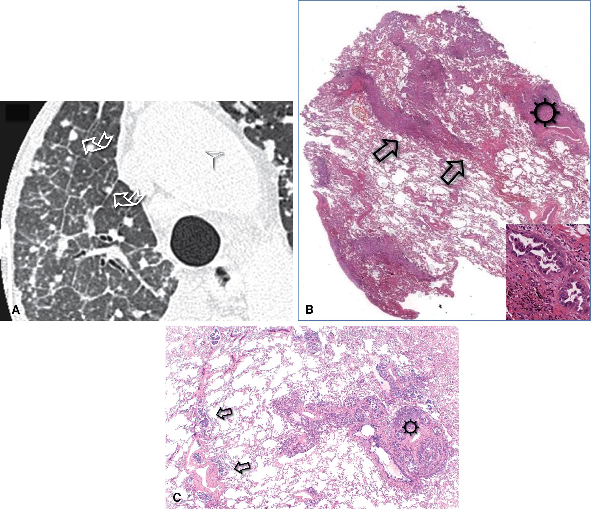 Figure 4.35, Septal pattern: subset nodular. (A) CT image shows septal thickening nodular in appearance (curved arrows) ; this has been termed the beaded septum sign. (B) On histology, interlobular septa (arrows) , together with some bronchovascular bundles (sun) , are thickened and nodular (lymphangitis carcinomatosis from metastatic pancreatic adenocarcinoma, H&E; inset, high power). (C) On histology, an interlobular septum (arrows) , together with a bronchovascular bundle (sun) , are thickened and nodular (lymphangitis carcinomatosis from metastatic breast carcinoma, H&E).