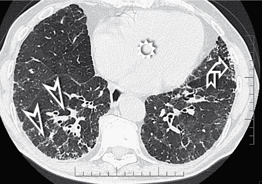 Figure 4.37, Diffuse interstitial amyloidosis. This axial scan at the level of the heart (sun) shows both smooth and nodular septal thickening (arrowheads) associated with well-defined subpleural nodules (curved arrow) .