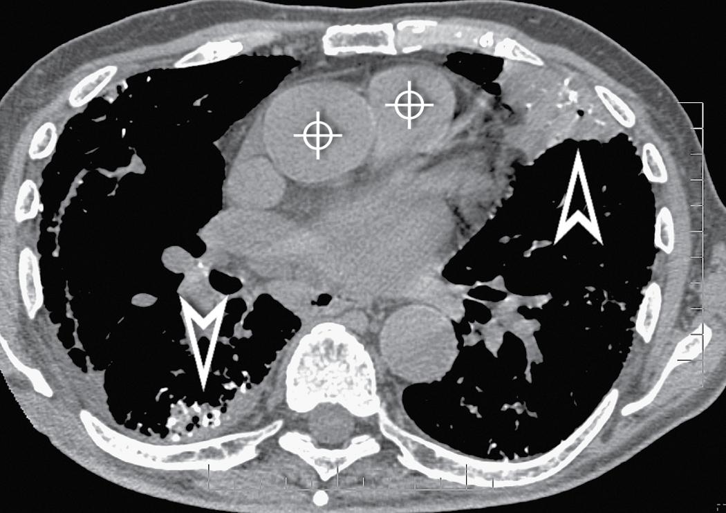 Figure 4.39, Mediastinal window at the level of the great vessels (bull’s-eyes) in the same patient as Fig. 4.37 . The image shows patchy peripheral calcified consolidations in both lungs (arrowheads) .