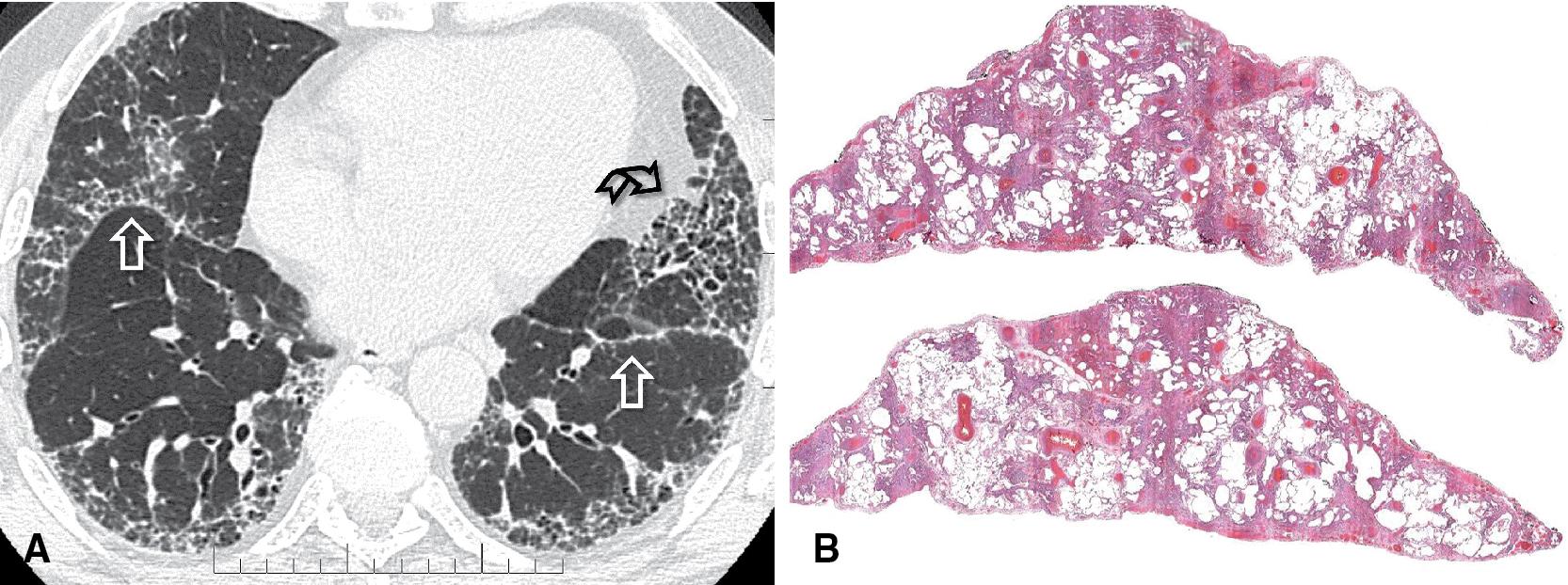 Figure 4.40, Fibrotic pattern. Rad-Path correlation. The signs of retraction and remodeling on the pulmonary structures are the key elements to identify this pattern. (A) Note indeed on the CT image the festooned course of the fissures, mostly on the right (arrows) and the traction phenomena along the mediastinal left profile (curved arrow). (B) On histology, fibrotic remodeling of the lung parenchyma is evident at low power.