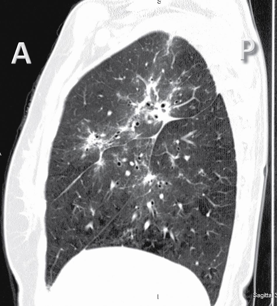 Figure 4.4, Computed tomography sagittal (lateral) view of the right lung (case with lung pathology). In the sagittal images, the anteroposterior and the craniocaudal directions are explored. A , Anterior; P , posterior.