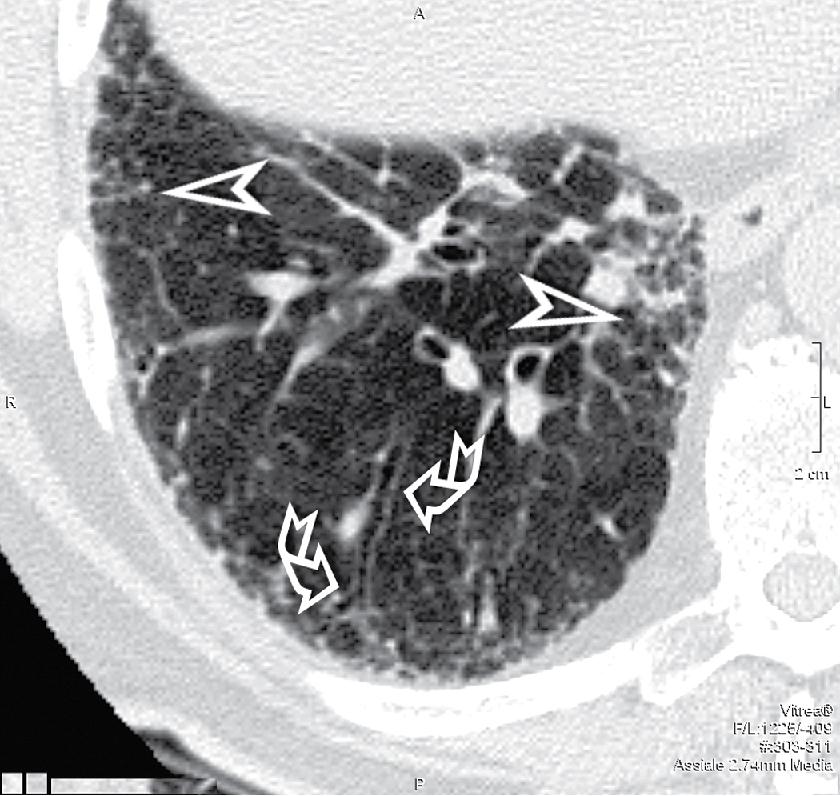 Figure 4.41, Irregular linear opacities (irregular reticulation) at the periphery of the lung (arrowheads) with remodeling of the lobular architecture, which is no longer recognizable. Signs of retraction are also evident on the bronchial structures with bronchiectases and bronchiolectases (curved arrows) .