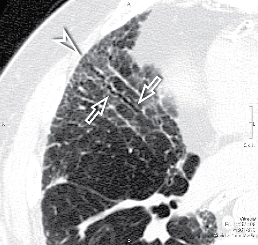 Figure 4.42, Tiny irregular lines in the anterior portion of the right lung. A long, ectatic, winding bronchus with thickened walls is clearly appreciable (arrows) . The ground-glass component of the image is probably a fibrotic ground-glass opacity due to concomitant irregular reticulation and bronchiolectases (arrowhead) .