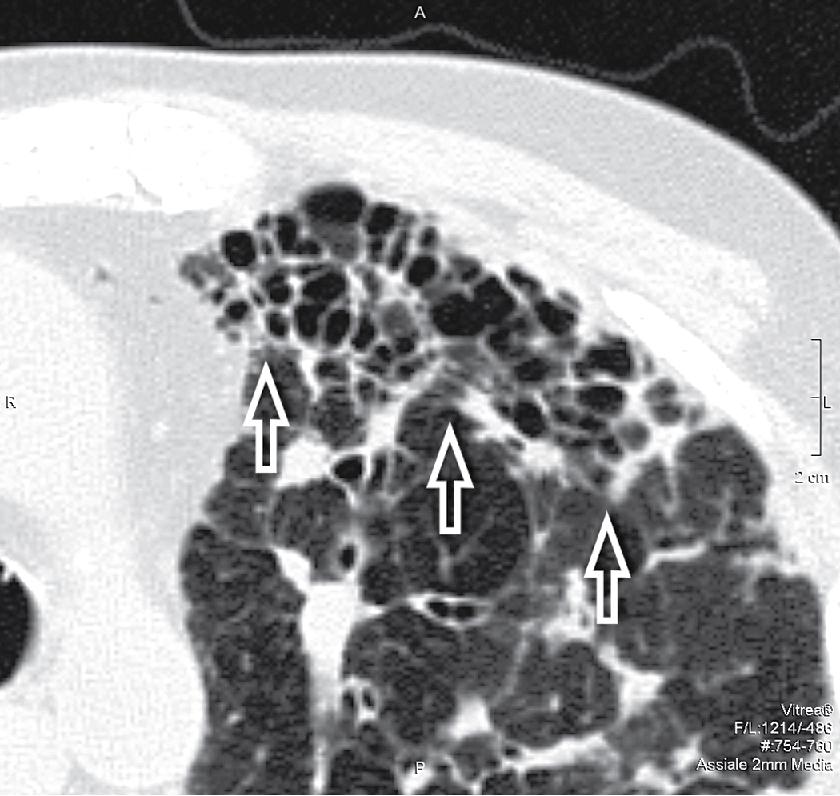 Figure 4.43, This is an example of what is called honeycombing radiologically (arrows) —multiple air-containing hyperlucent spaces (black holes) with well-defined thick walls grouped in several layers in an area of complete loss of the lobular architecture.