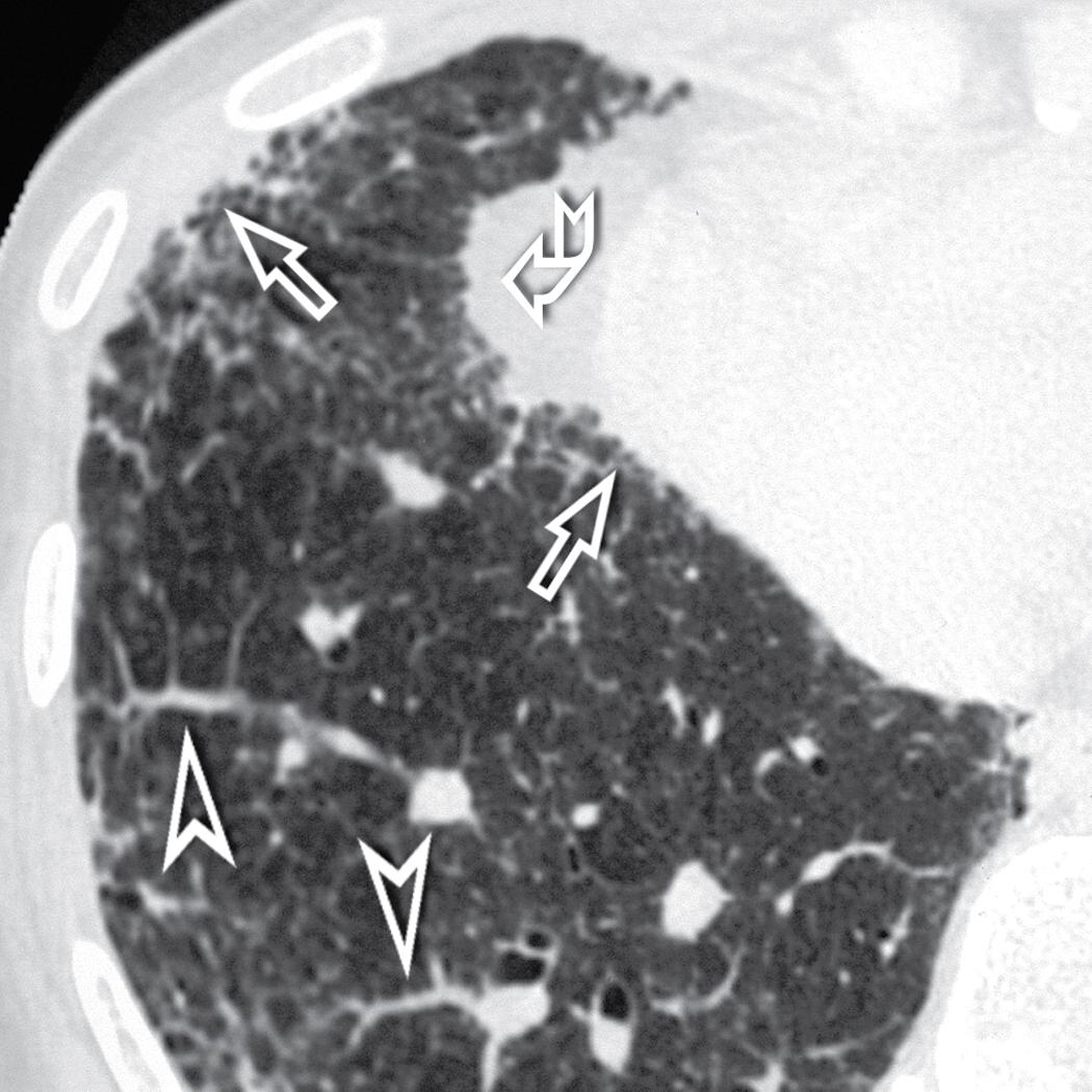 Figure 4.44, Shaggy margins of pleura (arrows) and vessels (arrowheads) (interface sign) and retraction of extrapulmonary structures toward the shrunk lung (curved arrow) are also indications of an underlying pulmonary fibrosing disorder.