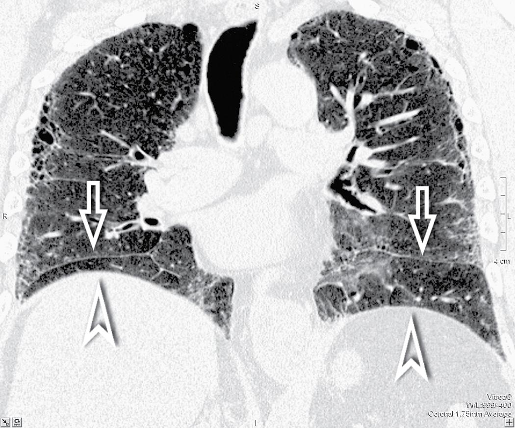 Figure 4.45, In this advanced fibrosing disease, the volume of the lower lung is markedly reduced, as shown by high diaphragmatic domes (arrowheads) approaching lowered fissures (arrows) .