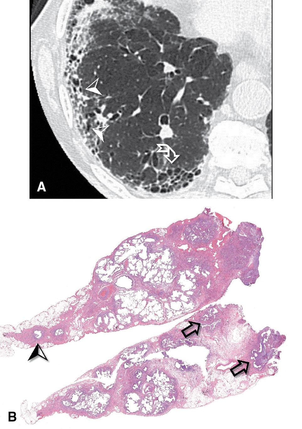 Figure 4.46, Fibrotic pattern, subset usual interstitial pneumonia. (A) High-resolution computed tomography image shows basal cluster of subpleural honeycombing (curved arrow) together with patchy fibrosing reticulation and traction bronchiolectasis (arrowheads) . (B) Histology shows patchy, dense, subpleural fibrosis with honeycombing (arrows) and bronchiectasis (arrowhead) .