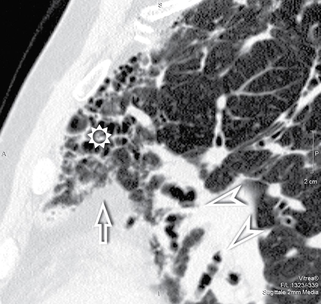 Figure 4.47, This sagittal view shows several signs of an important fibrosing pulmonary disorder: honeycombing in the anterior portions of the lung (sun) , retraction of the mediastinal fat (arrow) , and displacement of several ectatic bronchi (arrowheads) .