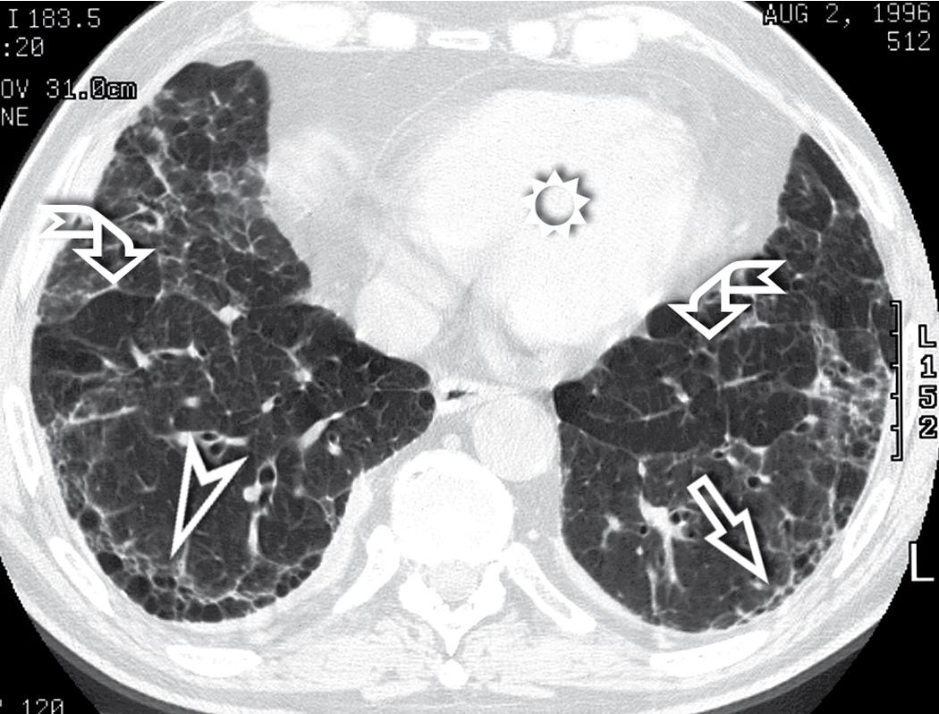 Figure 4.48, Axial scan at the level of the heart (sun) in a patient with asbestosis. Areas of advanced fibrosis with honeycombing (arrowhead) are seen, but also evident are more initial subpleural lines with a beaded appearance (arrow) . The pattern is completed in this case by patchy areas of mosaic oligemia vs oligoemia (curved arrows) .