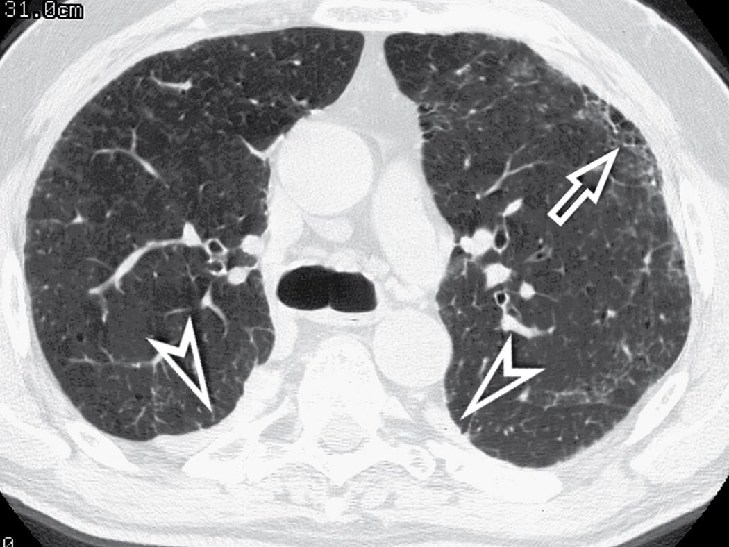 Figure 4.49, Axial scan at the carinal level in the same patient as in Fig. 4.48 . At this transversal level, the fibrotic involvement of the lung is only initial, and the honeycomb changes are confined into restricted areas (arrow) . Bilaterally there are typical pleural plaques (arrowheads) .