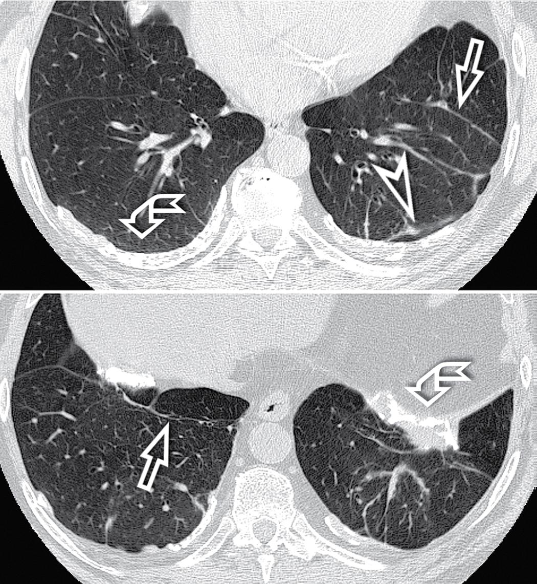 Figure 4.50, Calcified pleural plaques (curved arrows) , subpleural lines (arrowhead) , and parenchymal bands (arrows) are variably distributed in this patient with initial parenchymal asbestosis.