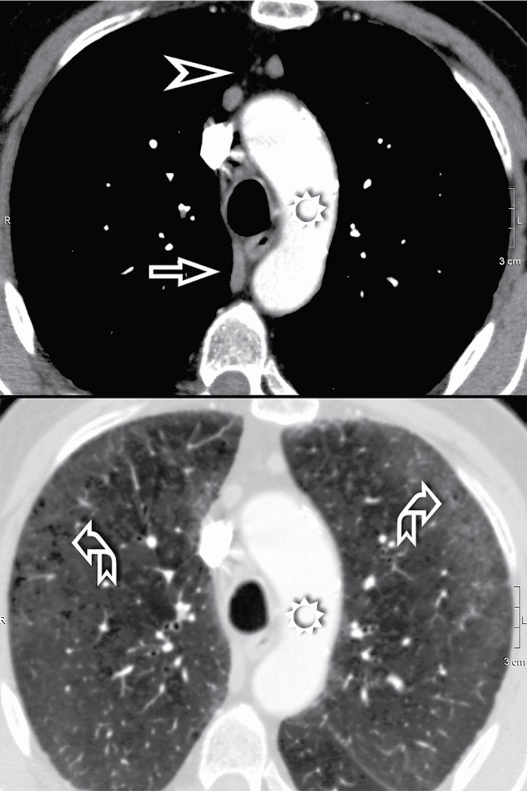 Figure 4.5, Effect of different window settings on the same image at the level of the aortic arch (sun) . The upper figure has been documented with a mediastinal window that optimizes the contrast of the details at the soft tissue level. The azygos vein (arrow) , for example, and a couple of small lymph nodes in the anterior mediastinum (arrowhead) are nicely seen. The lung window (lower image) , on the contrary, optimizes contrast at the lung level, allowing the recognition of small hyperlucencies (curved arrows) inside faint peripheral lung opacity.