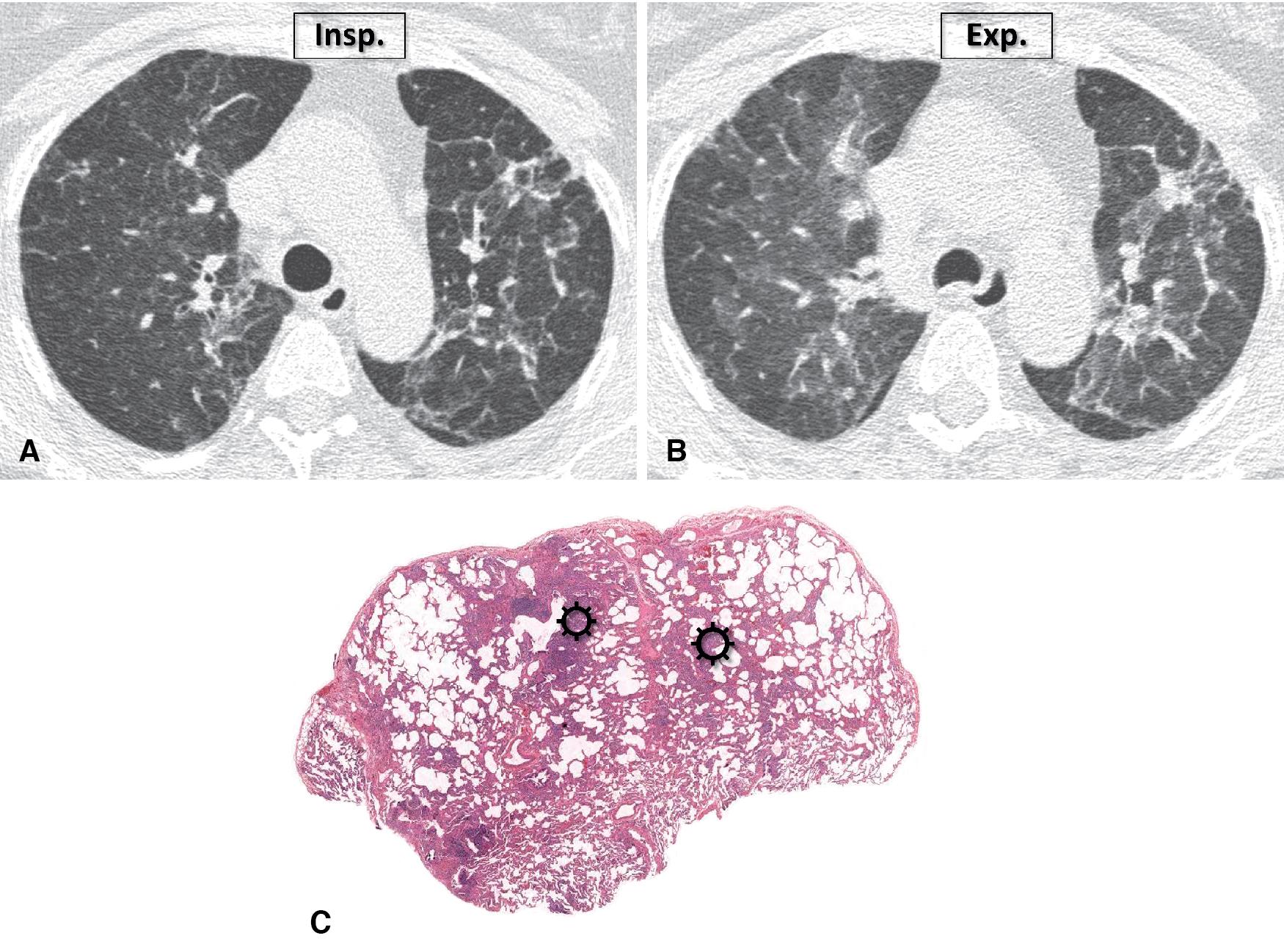 Figure 4.51, Fibrotic HP (hypersensitivity pneumonitis). (A) Bronchocentric fibrosis and the so-called “three-density sign” are present with differential lung density including ground-glass opacity and low-density lobules. (B) The latter aspect is more visible in the expiratory phase. (C) Chronic hypersensitivity pneumonitis, centrilobular fibrotic type. There is mild fibrosis with a chronic inflammatory infiltrate in a centrilobular pattern (suns) . Exp ., Expiratory scan; Insp ., inspiratory scan.