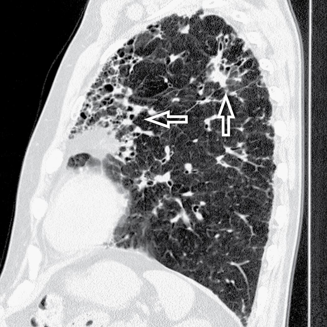 Figure 4.52, The lesions of chronic hypersensitivity pneumonitis tend to prevail in the upper regions of the lung (arrows) ; this is true also for honeycombing. In this sagittal view of the left lung, the base of the lung is relatively free of lesions. This is an important element in the differential diagnosis with idiopathic usual interstitial pneumonia.