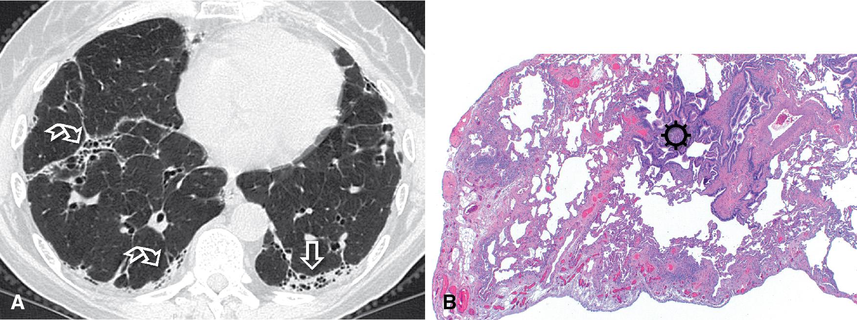 Figure 4.53, Fibrotic hypersensitivity pneumonitis (HP). (A) High-resolution computed tomography shows patchy areas of subpleural fibrosis (curved arrows) including honeycombing (arrow) with lower zone distribution. This aspect is indistinguishable from a usual interstitial pneumonia (UIP) pattern of fibrosis in patients with idiopathic pulmonary fibrosis. (B) Predominantly subpleural fibrosis: prominent peribronchiolar metaplasia is readily apparent at low power (sun) .