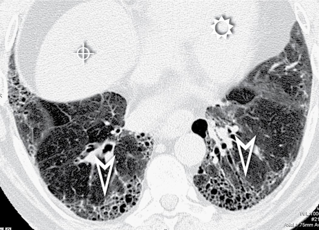 Figure 4.54, Axial scan at the level of the right liver dome (bull’s-eye) and of the heart base (sun) in a patient with idiopathic usual interstitial pneumonia. Areas of patchy honeycombing alternating with normal lung are present (arrowheads) and are typical of this disease.