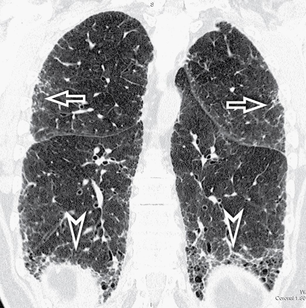 Figure 4.55, The peripheral regions of both lungs in this frontal view of a patient with idiopathic usual interstitial pneumonia show an irregular reticulation superiorly (arrows) ; typical honeycombing is present at the basal level (arrowheads) .