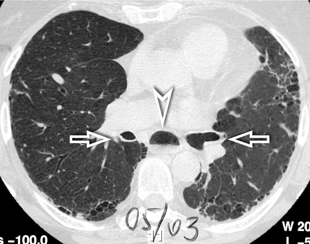 Figure 4.56, Patchy honeycombing alternating with normal lung (usual interstitial pneumonia subset) in a patient with systemic sclerosis. In this axial scan at the subcarinal level, an enlarged esophagus with an air-fluid level is visible (arrowhead) between the intermediate bronchus at the right and the junction of the upper and lower lobe bronchi at the left (arrows) .