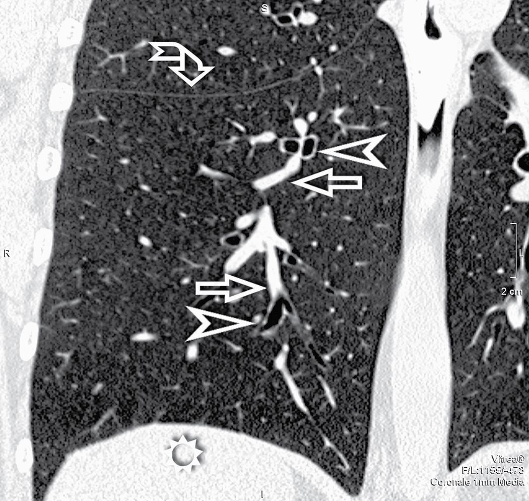 Figure 4.6, Frontal view of a normal right lung, inferiorly delimited by the diaphragmatic dome (above the sun ). White lines and dots within the pulmonary parenchyma are vessels (arrows) . Black lines and rings are bronchi (arrowheads) . The figure also shows a pleural fissure (curved arrow) .